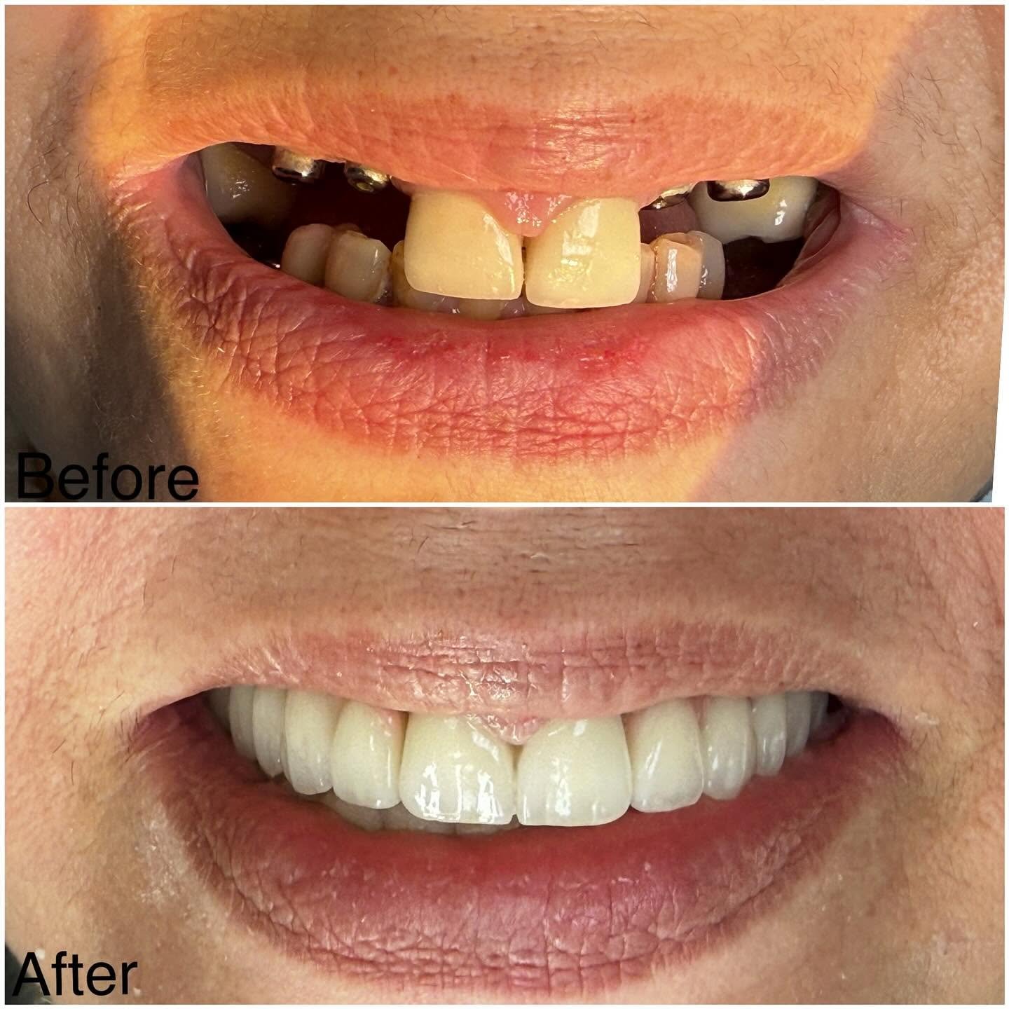 Implants and restorations before and after result